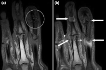 Arthritis psoriatica – Wikipédia