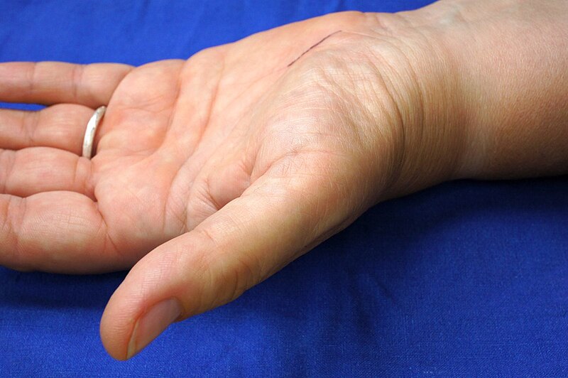 carpal tunnel syndrome was ist das