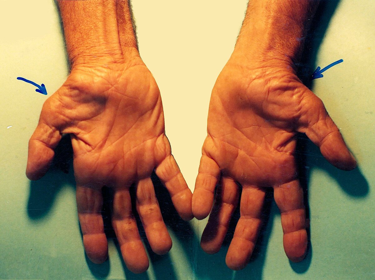 carpal tunnel syndrome was ist das