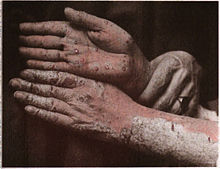 psoriatic arthritis wiki