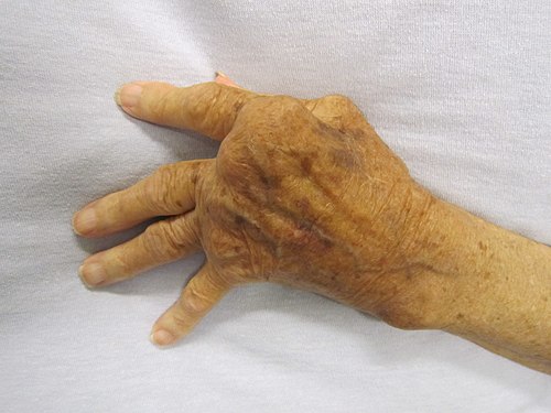 costa arthrosis és kezelés