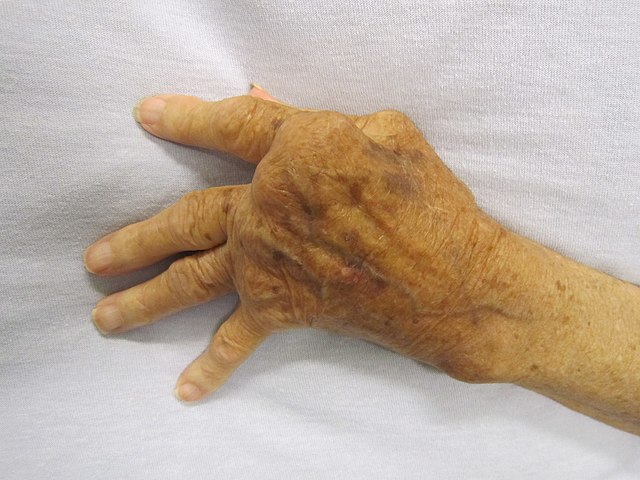 rheumatoid arthritis és osteoarthritis