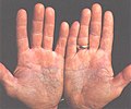 psoriatic arthritis wiki