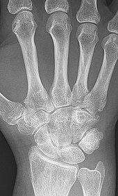mely országokban kezelik a rheumatoid arthritist