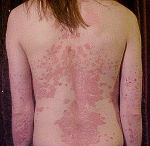 psoriatic arthritis wiki