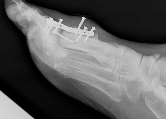 1st metatarsophalangeal joint osteoarthritis icd 10)