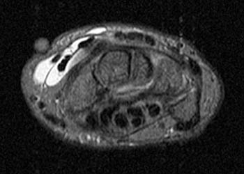 intersection syndrome radiology)