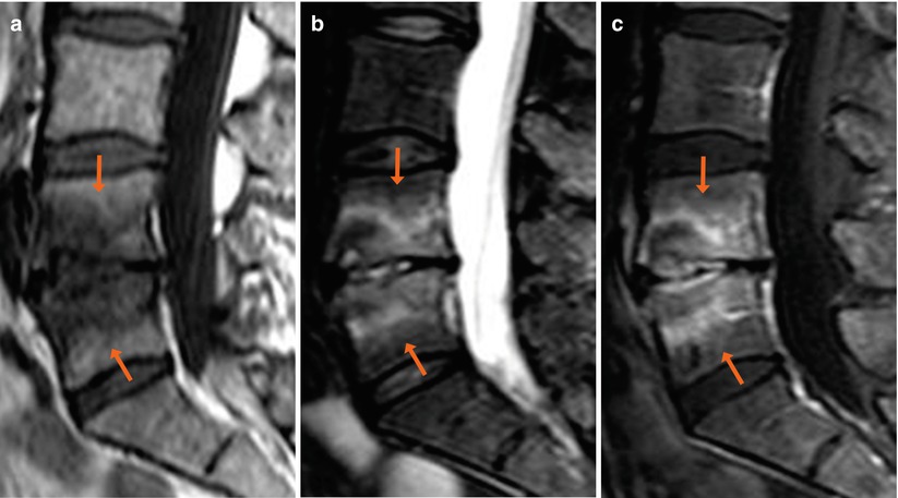 osteochondrosis s1