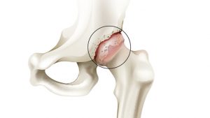 hip synovitis hogyan kell kezelni