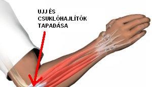Könyökfájdalom gyakori okai - Dr. Zátrok Zsolt blog