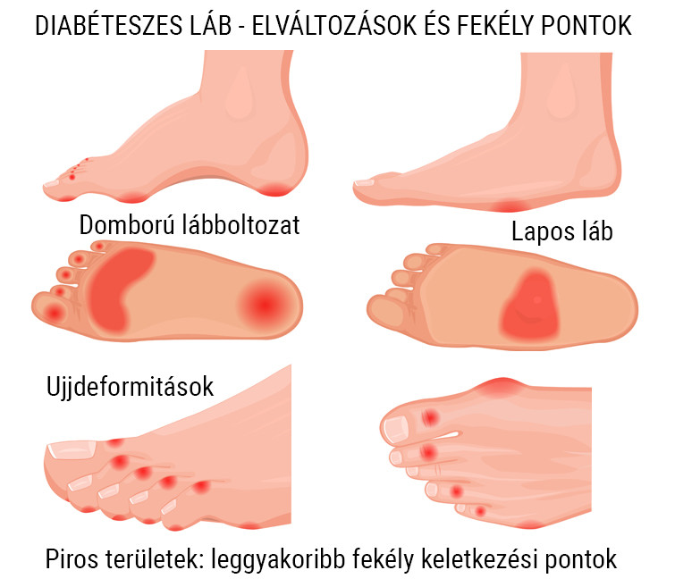 boka duzzanat cukorbetegség esetén)