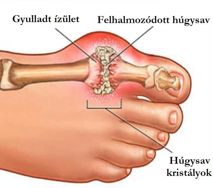 meddig kezelik az ízületi gyulladást)