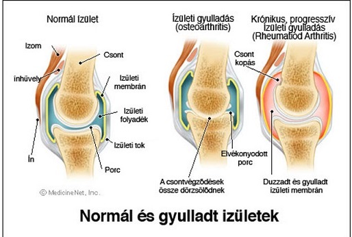 A térdízület kopása: tünetek, kivizsgálás és kezelés Térdízület ízületi gyulladása 1 fokú kezelés