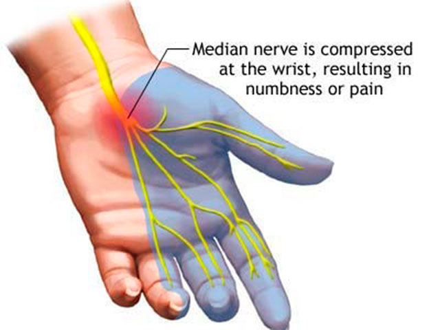 carpal tunnel syndrome was ist das