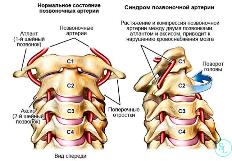 térd osteochondrosis vélemények)