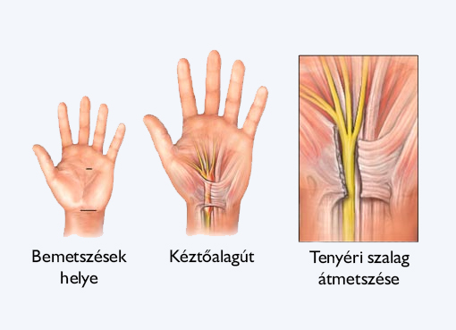 alagút szindróma gyógyítása)