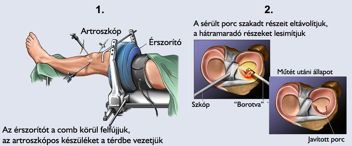merev térd műtét után)