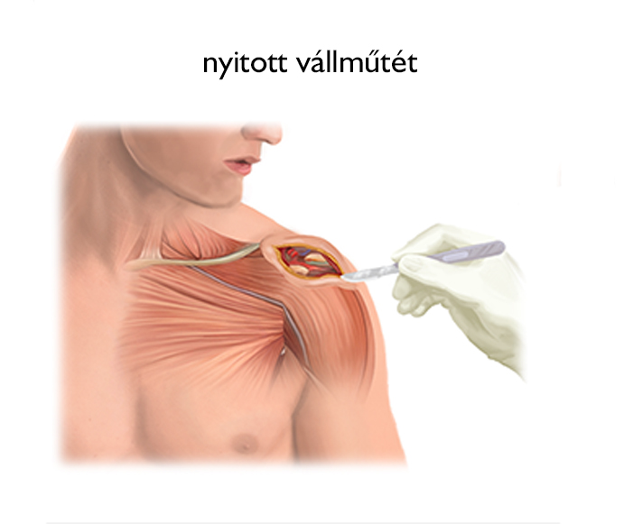 fájdalom a vállízület műtétje után