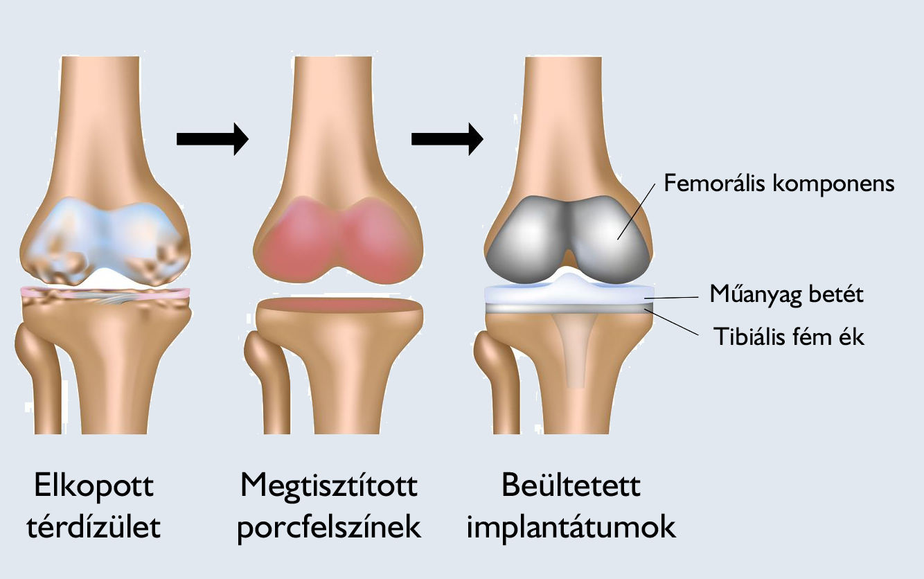fájó térdízületek megszabadultak a fájdalomtól