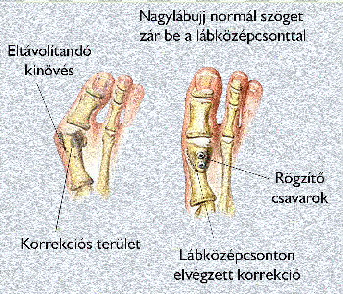 ízületi műtéti kezelés fájdalom közös egér