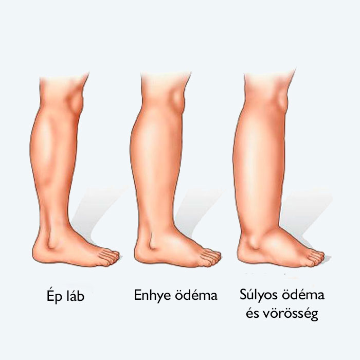 Zúzódás a térden: Ennyi idő alatt gyógyul