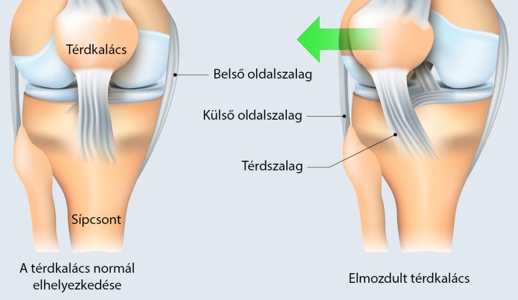 a térd tünetei és betegségei