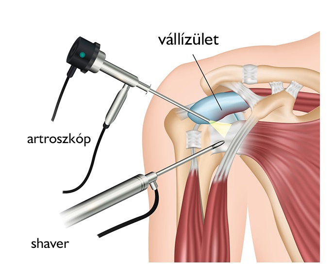 Vállműtét (stabilizációs műtétek, nyitott vállműtét) - Medicover