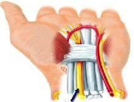 carpal tunnel syndrome was ist das