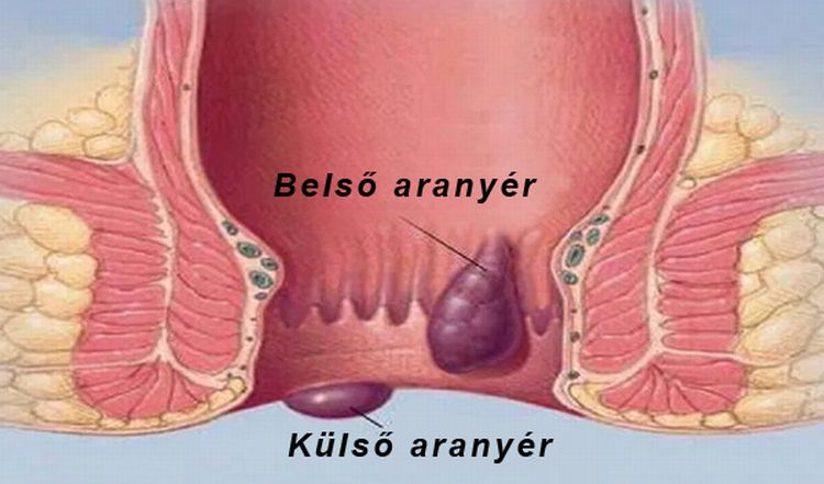 aranyér közös kezelése)