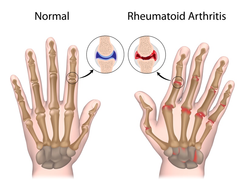 rheumatoid arthritis ahol kezelni