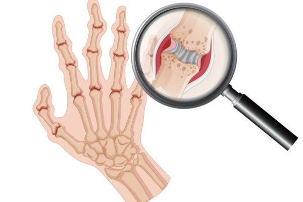 rheumatoid arthritis nem kezelhető)