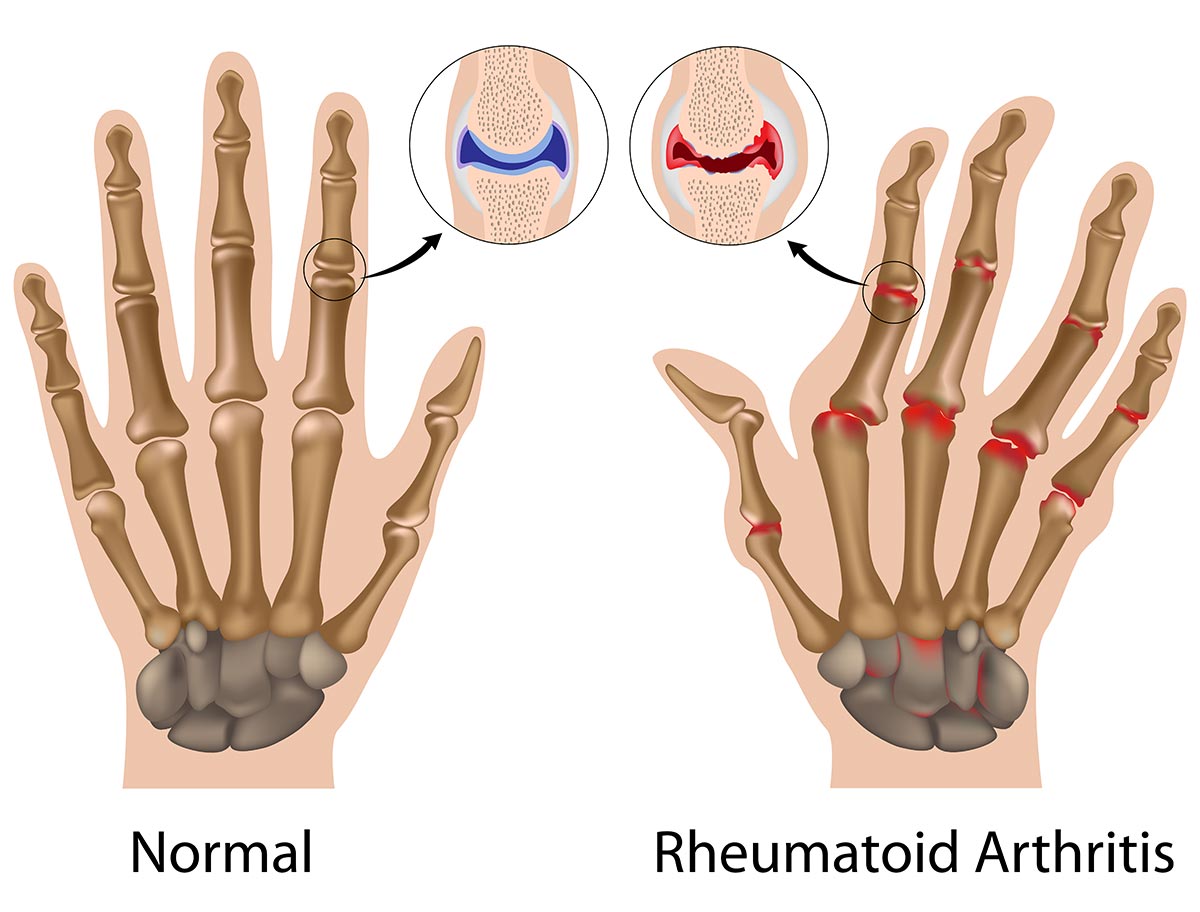 rheumatoid arthritis)