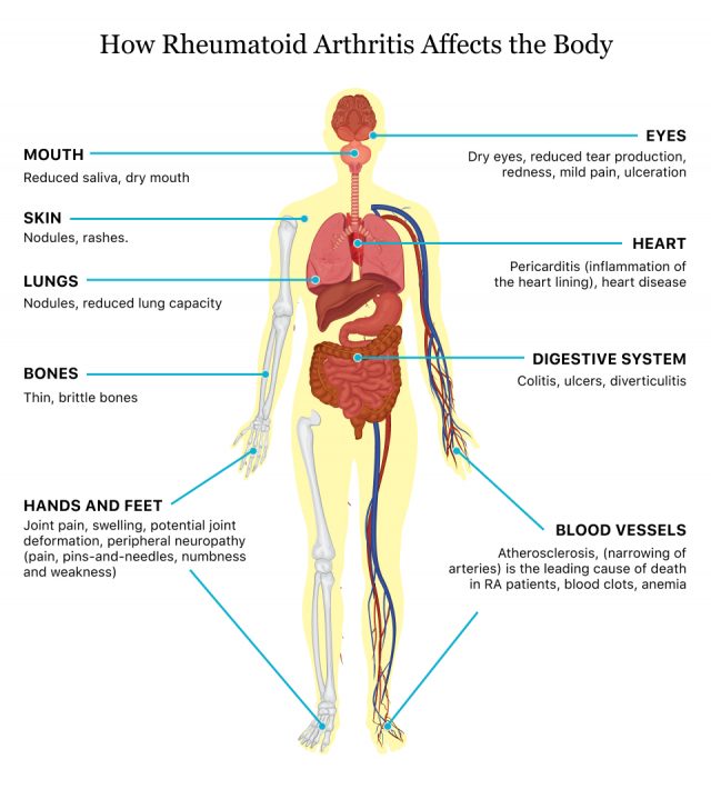 rheumatoid arthritis early stages