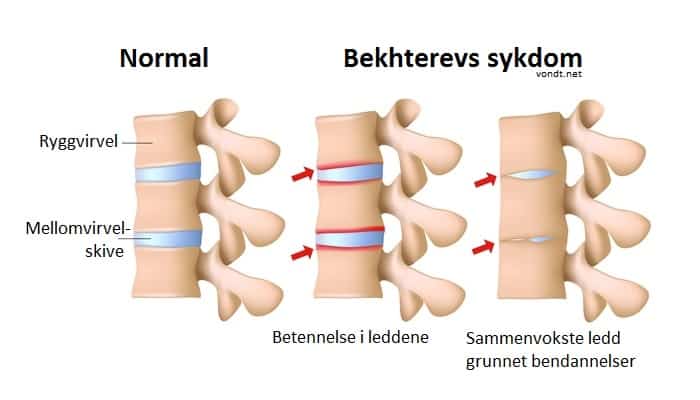csigolya osteoarthritis
