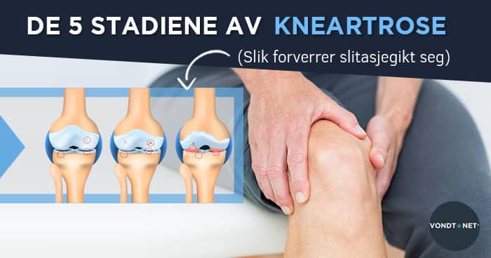 a térdízület kezelésének első szakaszában szenvedő osteoarthritis)